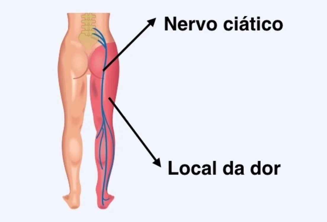 6 Exercícios para Dor no Nervo Ciático: Descompressão do Nervo ...