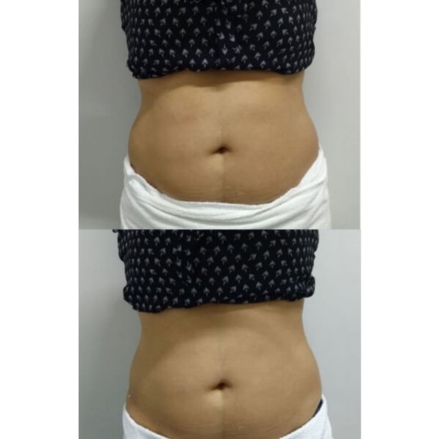 Lipocavity New Ultracavitação e Ondas de Choque + Kit Wave | HS Med ...