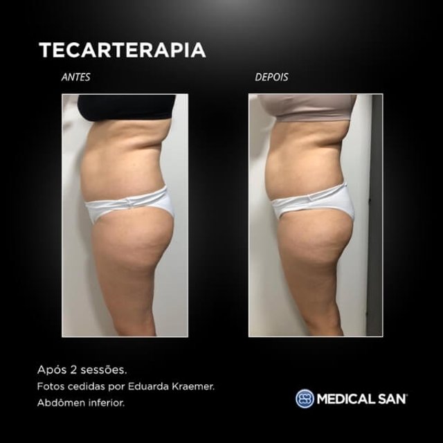 Tekah Evolution Smart - Aparelho De Tecarterapia E Radiofrequência - Medical San