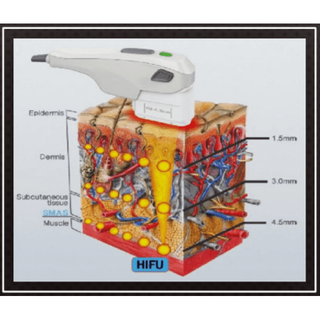 Ultramed Hifu Medical San - Aparelho de Ultrassom Microfocado com 3 Cartuchos 