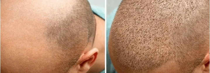 Imagem Exemplos Transplantado