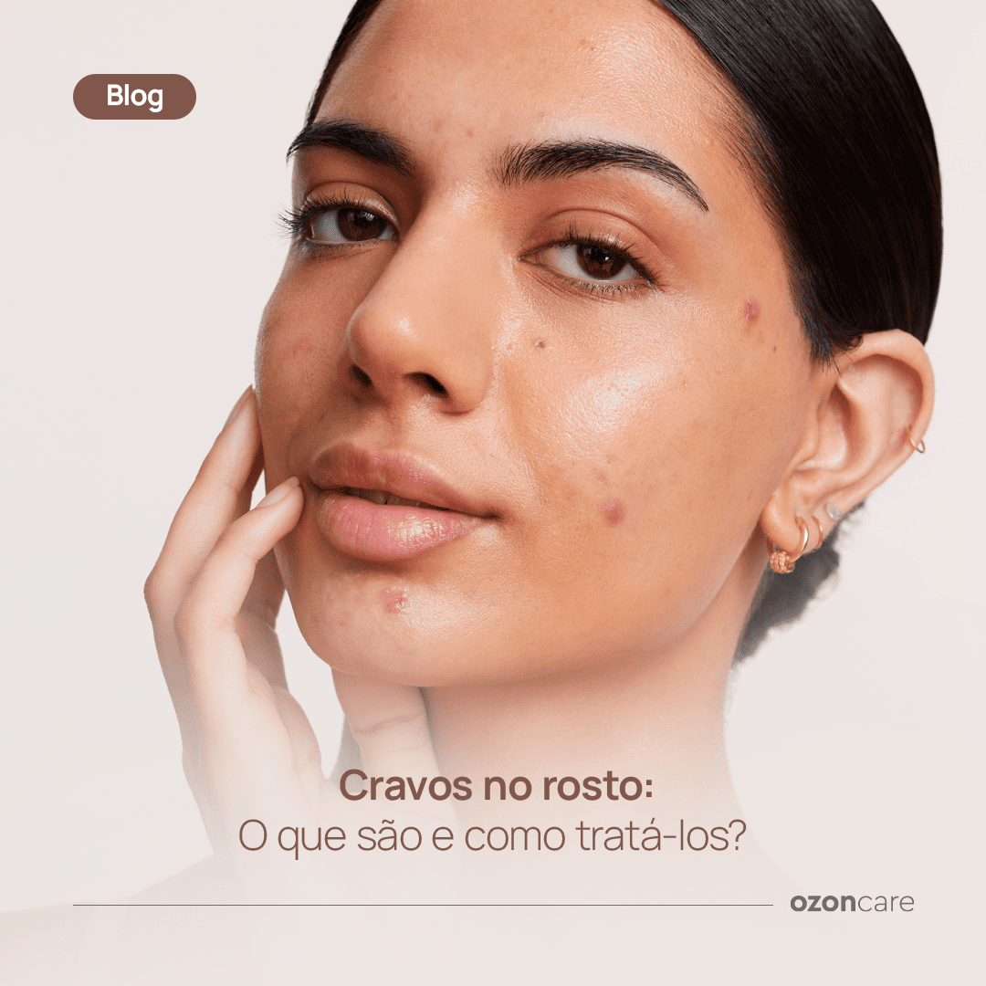 Cravos no Rosto: O que São, Como Tratar e Solução com Loção ...