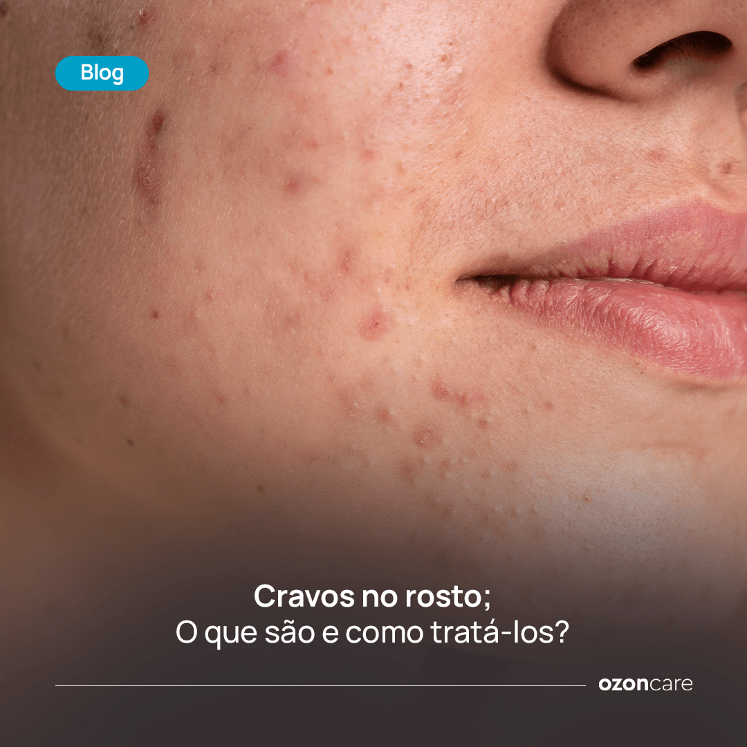 Cravos no Rosto: Como Tratar e Prevenir com Skincare Inteligente ...