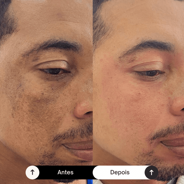 KIT Completo Melasma Masculino - 5 Produtos | Am Nutrifarma